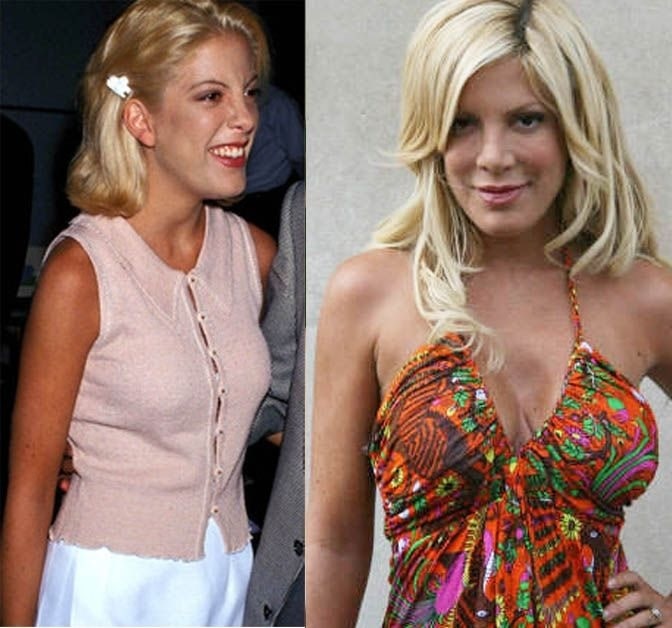 A picture of Tori Spelling before (left) and after (right) breast implants.